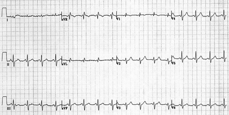 modified ecg